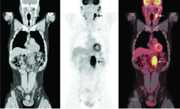 positron emission tomography (pet)